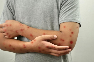 OMS advierte que más de la mitad de países del planeta están en riesgo de brotes de sarampión